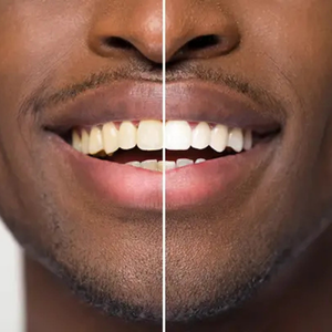 LumaSmile™ Teeth Whitening Powder
